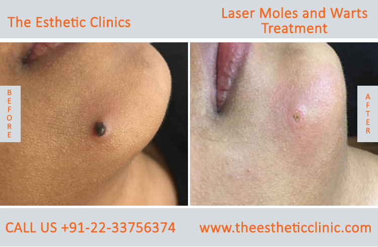 Moles Wart Skin Tags Laser Treatment before after photos in mumbai india (4)